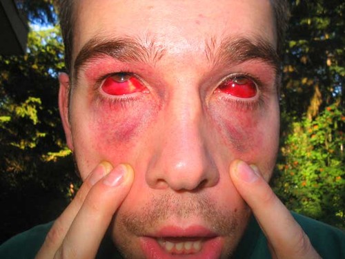 This is what happens when you don't repressurize your mask when scuba diving...Lucky he still has his vision...