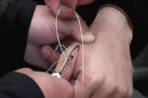 Nasty Fish Hook Removal