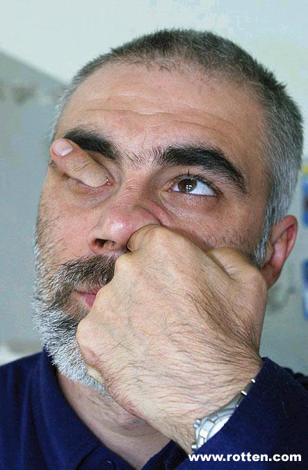 When picking your nose goes horribly wrong